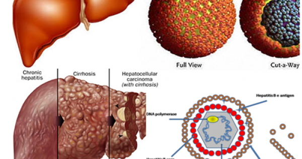 Gần 9 triệu người viêm gan: Kiệt quệ với “kẻ giết người thầm lặng”
