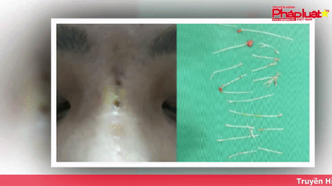 Mũi nữ diễn viên thủng nhiều lỗ sau 2 tháng cấy chỉ nâng mũi