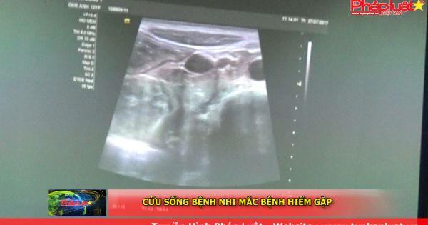 Cứu sống bệnh nhi mắc bệnh hiếm gặp