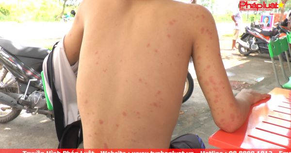 Nạn rệp ở các khu ký túc xá sinh viên