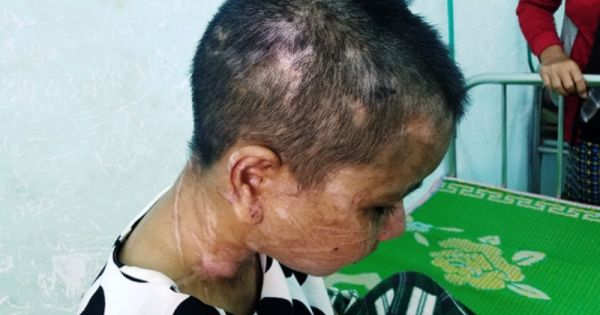 UBND tỉnh Gia Lai chỉ đạo làm rõ vụ người giúp việc bị tra tấn man rợ