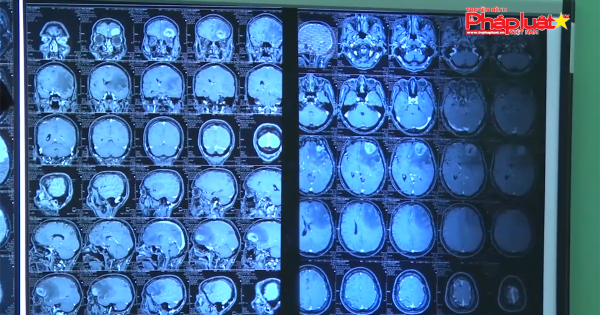 Bệnh nhận bị ký sinh trùng dài 7 cm chui vào não