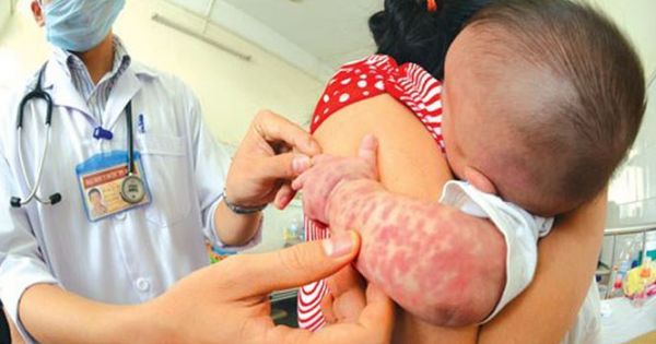 Nguy cơ bùng phát dịch sởi: Cách tránh bệnh hiệu quả