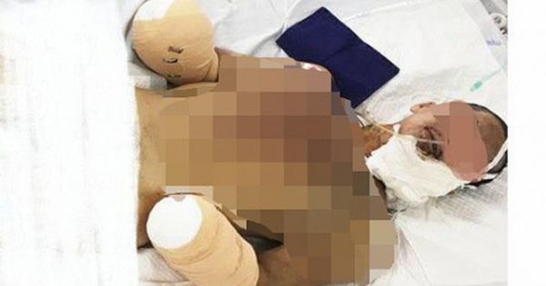 Nam thanh niên bị cụt hai tay, gãy xương hàm vì tự chế pháo nổ