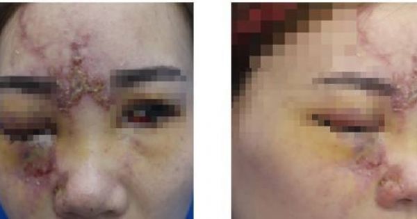 Tiêm filler nâng mũi, cô gái 27 tuổi mù 1 mắt