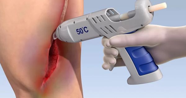 Thử nghiệm súng bắn keo sinh học chữa lành vết thương