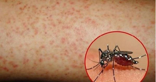 Gần 5.000 ca mắc sốt xuất huyết ở Quảng Nam