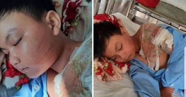 Nghi án bé trai bị cha ruột tạt nước sôi, gây bỏng nặng
