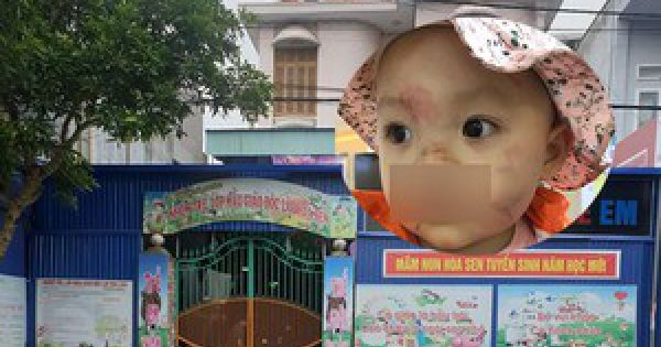 Bé gái 14 tháng tuổi bị nhiều thương tích sau buổi học ở lớp mầm non