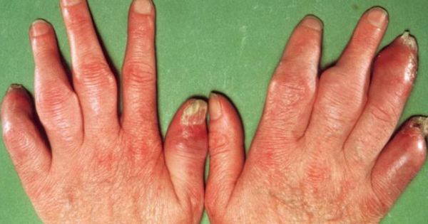 Toàn thân sưng đỏ, khớp biến dạng vì uống thuốc nam điều trị vảy nến