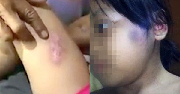 Bé gái bị cha dượng hờ bạo hành có tỷ lệ thương tích 51%