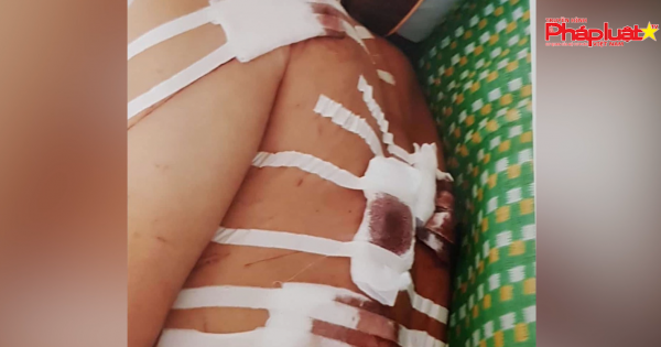 Bình Định: Người dân bị đâm 9 nhát, thương tích 23%, công an “ngâm” hồ sơ 6 tháng