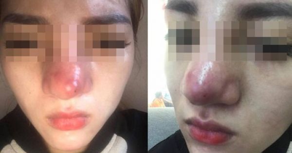 Sau khi tiêm kháng sinh tiền phẫu sửa mũi, nữ bệnh nhân ngưng tim, ngưng thở