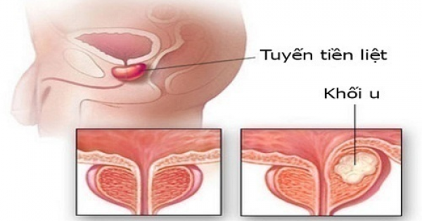 Xét nghiệm tại nhà phát hiện sớm ung thư tuyến tiền liệt