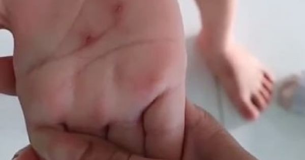 Buộc thôi việc cô giáo dùng vật nhọn đâm vào tay trẻ tại Bình Phước