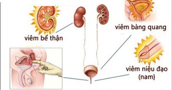 Bệnh “khó chịu” nhưng nhiều người chủ quan