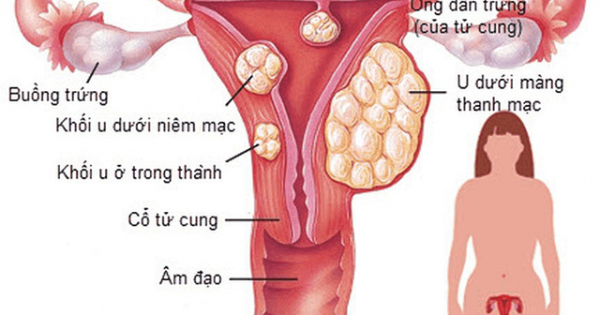 U xơ cơ tử cung - Nguyên nhân gây vô sinh, hiếm muộn dễ bị bỏ qua