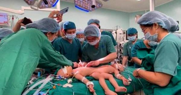 Sau 20 ngày mổ tách, hai bé song Nhi đã tự hít thở khí trời