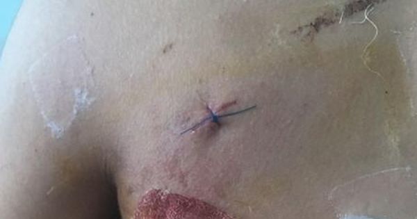 Va chạm xe nam sinh lớp 11 đâm bạn cùng trường