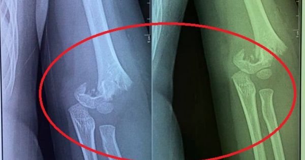 Làm rõ việc trường chậm đưa trẻ ngã gãy tay đi cấp cứu