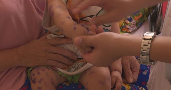 Bệnh tay chân miệng bùng phát tại Đắk Lắk