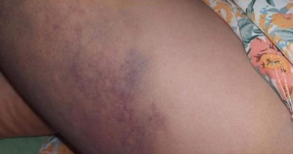 Tạm đình chỉ công tác giáo viên đánh học sinh lớp 3 bầm tím vùng đùi