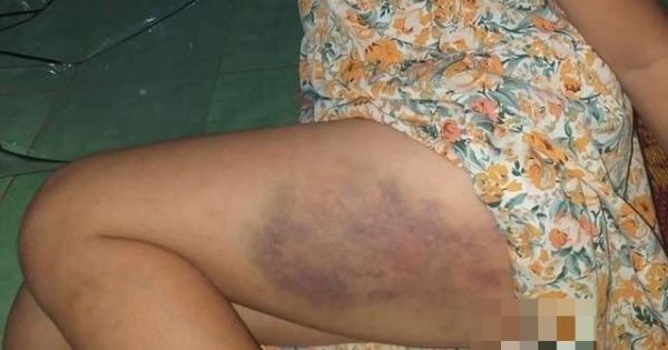 Vụ cô giáo dùng thước đánh bầm tím học sinh lớp 3: Hiệu trưởng cũng sẽ bị xử lý