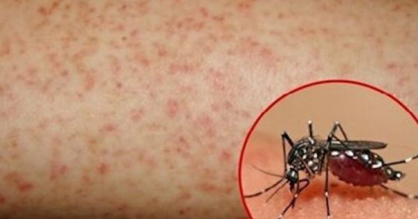 Hơn 84.000 trường hợp trên cả nước mắc sốt xuất huyết