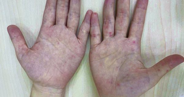 Người phụ nữ 32 tuổi mắc bệnh tay chân miệng là trường hợp hiếm gặp