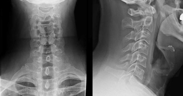 Một học sinh tiểu học bị đánh chấn thương đốt sống cổ