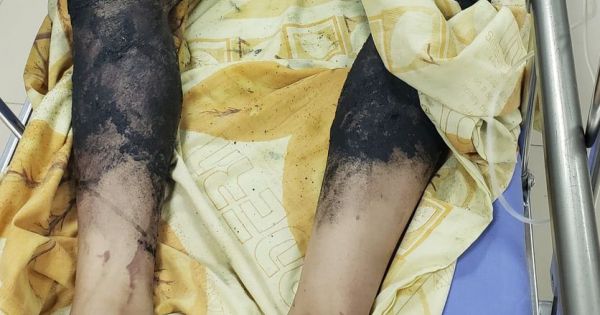 Làm thí nghiệm bằng cồn tại nhà, bé trai bị bỏng nặng