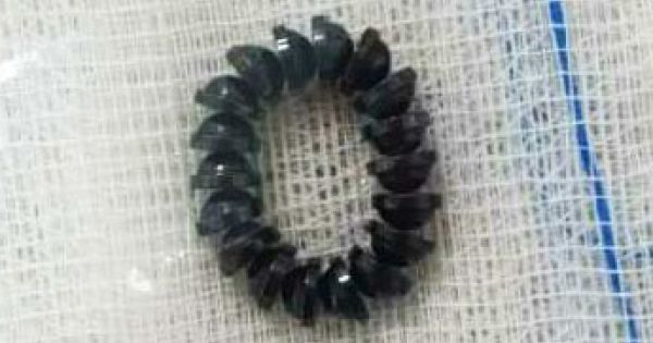 Kịp thời phẫu thuật lấy 18 bi nam châm trong bụng bé trai 34 tháng tuổi