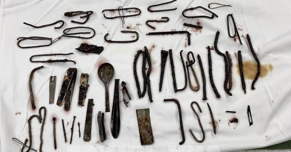 Phẫu thuật lấy ra khoảng 1 kg kim loại trong bụng một bệnh nhân