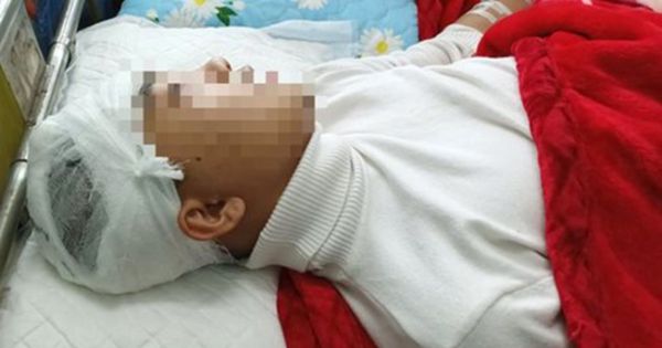 Khởi tố, bắt tạm giam nam sinh lớp 11 đánh bạn vỡ sọ não
