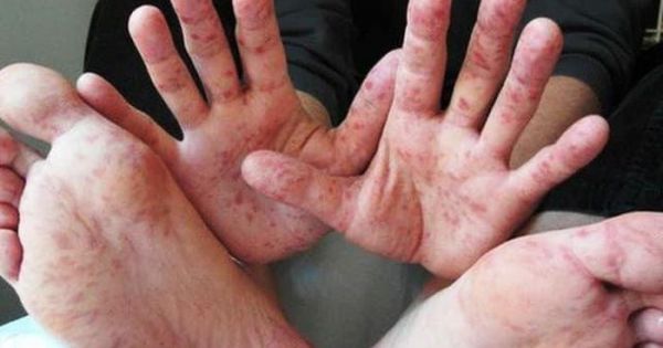 Gia tăng số ca mắc tay chân miệng tại Đồng Nai và Quảng Nam