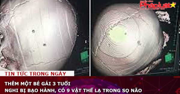 Thêm một bé gái 3 tuổi nghi bị bạo hành, có 9 vật thể lạ trong sọ não