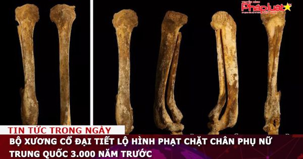 Bộ xương cổ đại tiết lộ hình phạt chặt chân phụ nữ Trung Quốc 3.000 năm trước