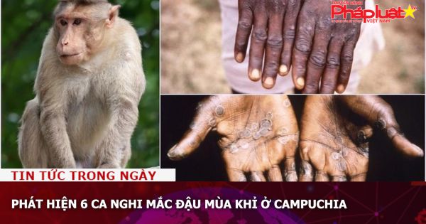 Phát hiện 6 ca nghi mắc đậu mùa khỉ ở Campuchia