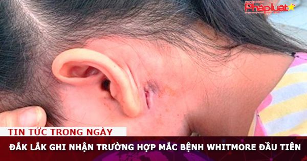 Đắk Lắk ghi nhận trường hợp mắc bệnh Whitmore đầu tiên