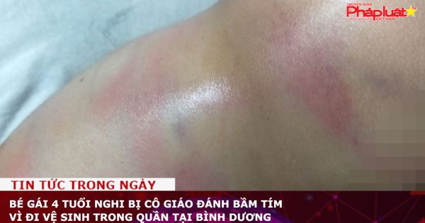 Bé gái 4 tuổi nghi bị cô giáo đánh bầm tím vì đi vệ sinh trong quần tại Bình Dương
