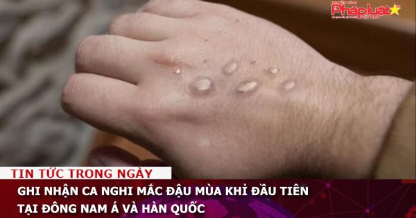 Ghi nhận ca nghi mắc đậu mùa khỉ đầu tiên tại Đông Nam Á và Hàn Quốc
