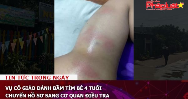 Vụ cô giáo đánh bầm tím bé 4 tuổi, chuyển hồ sơ sang cơ quan điều tra
