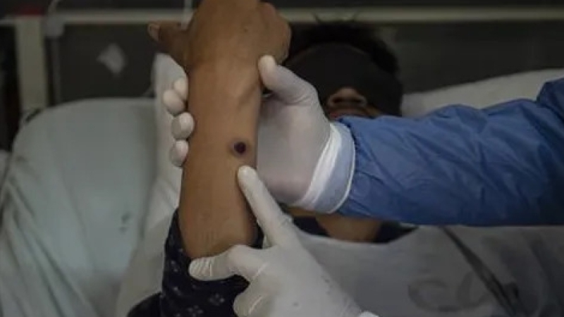 WHO: Bệnh đậu mùa khỉ vẫn là tình trạng khẩn cấp về sức khỏe cộng đồng toàn cầu