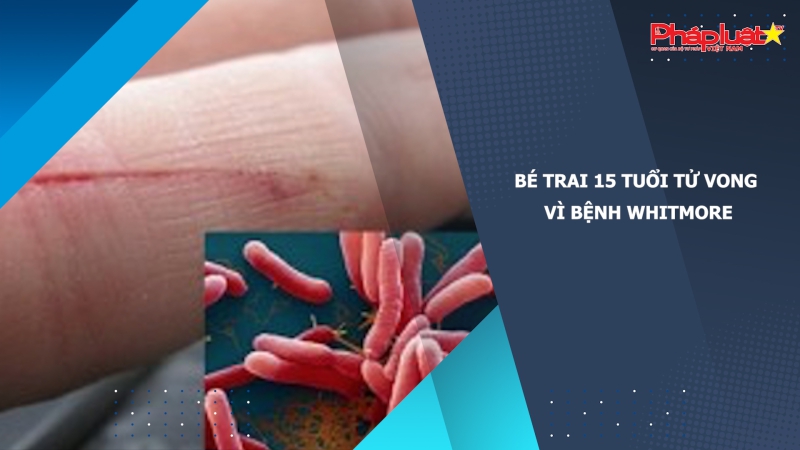 Bé trai 15 tuổi tử vong vì bệnh Whitmore