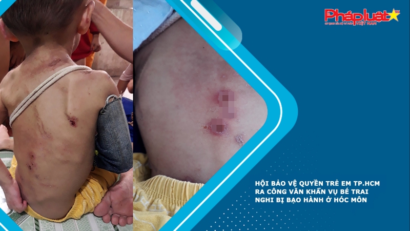 Hội Bảo vệ quyền trẻ em TP.HCM ra công văn khẩn vụ bé trai nghi bị bạo hành ở Hóc Môn