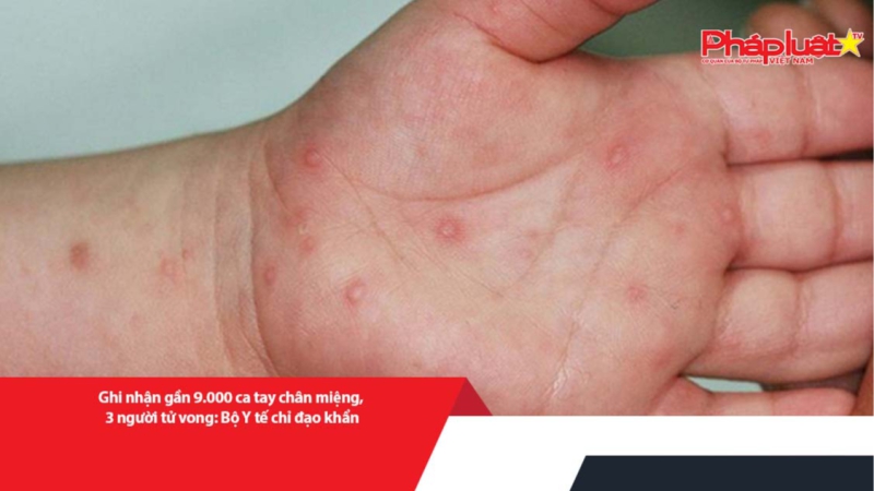 Ghi nhận gần 9.000 ca tay chân miệng, 3 người tử vong: Bộ Y tế chỉ đạo khẩn