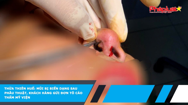 Bản tin Sức khỏe & Làm Đẹp- Thừa Thiên Huế: Mũi bị biến dạng sau phẫu thuật, khách hàng gửi đơn tô cáo thẩm mỹ viện
